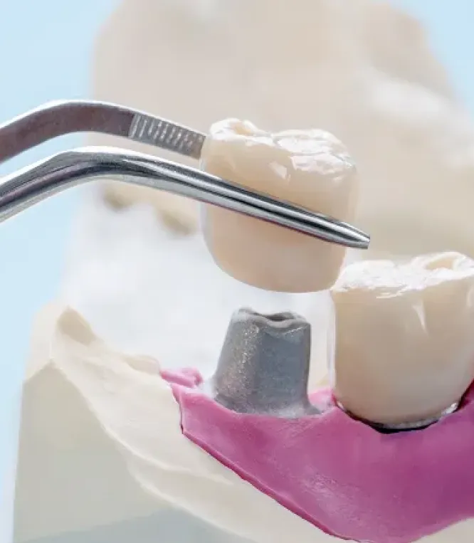 Dental Implants at Joobbani Dental Designs in Columbia, Maryland